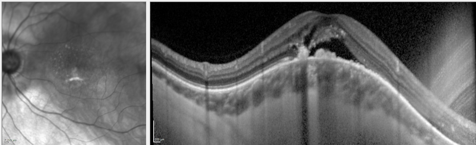 <p>Dome-Shaped Maculopathy on Vertical Optical Coherence Tomography Scan