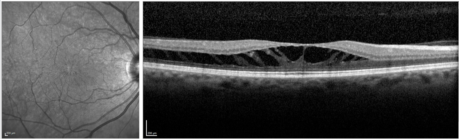 <p>Myopic Macular Schisis