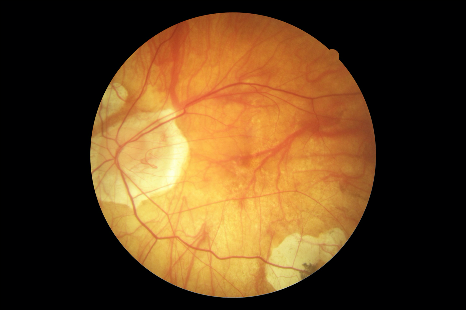 <p>Grade 3 Pathological Myopia With Diffuse Chorioretinal Atrophy