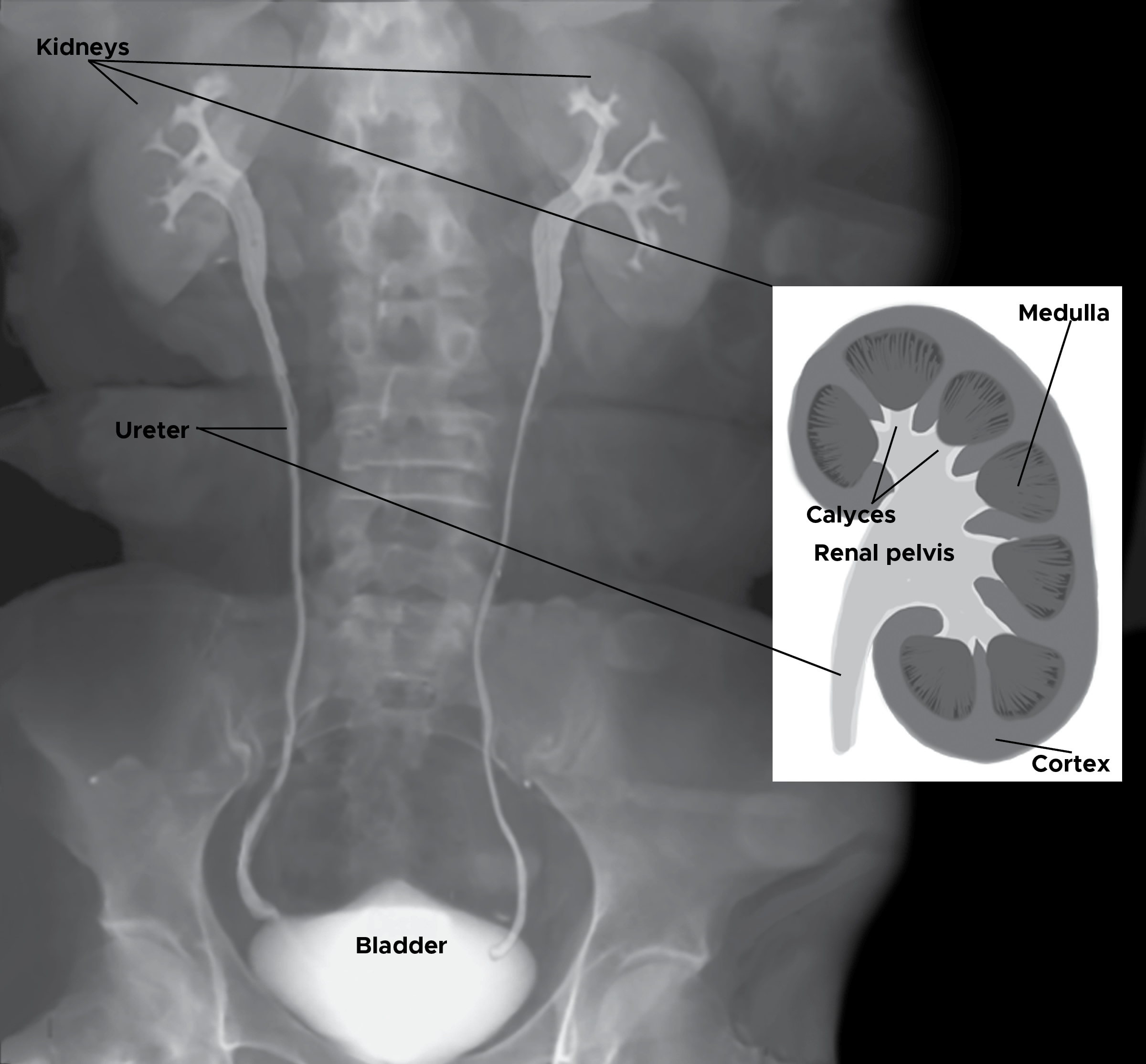 <p>Normal Retrograde Pyelogram