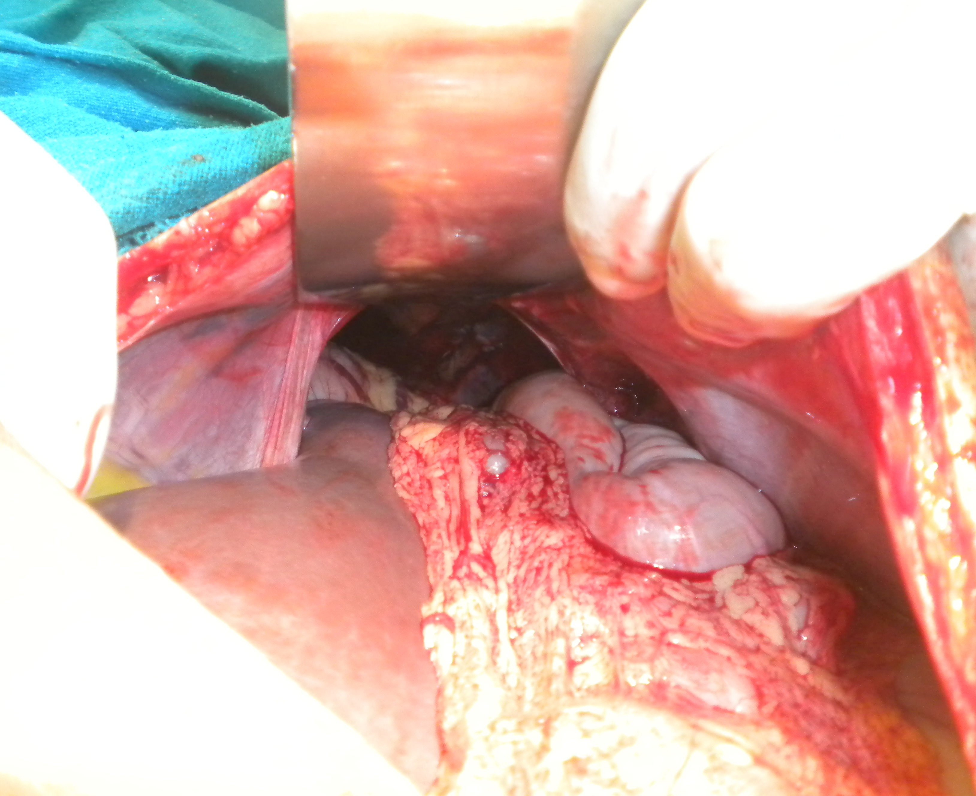 <p>Traumatic Diaphragmatic Hernia