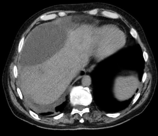 CT image showing hepatic biloma.