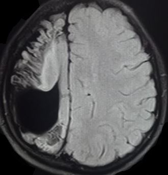 Seizure from the cortical changes and porencephalic cyst in a child secondary to a vascular insult sustained in a neonatal period