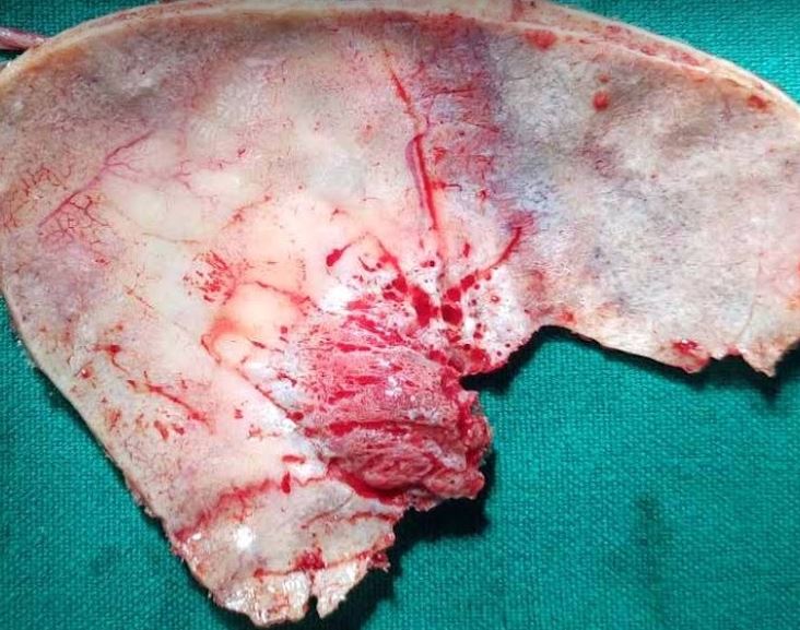 Hyperostotic bone in meningioma