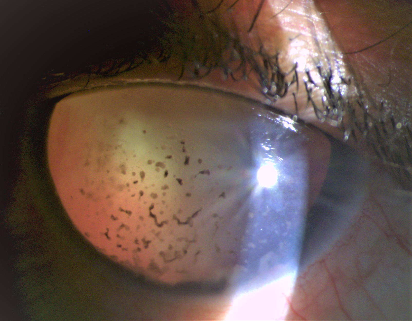 <p>Phacoanaphylactic Glaucoma</p>