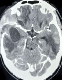 <p>Temporal Abscess</p>