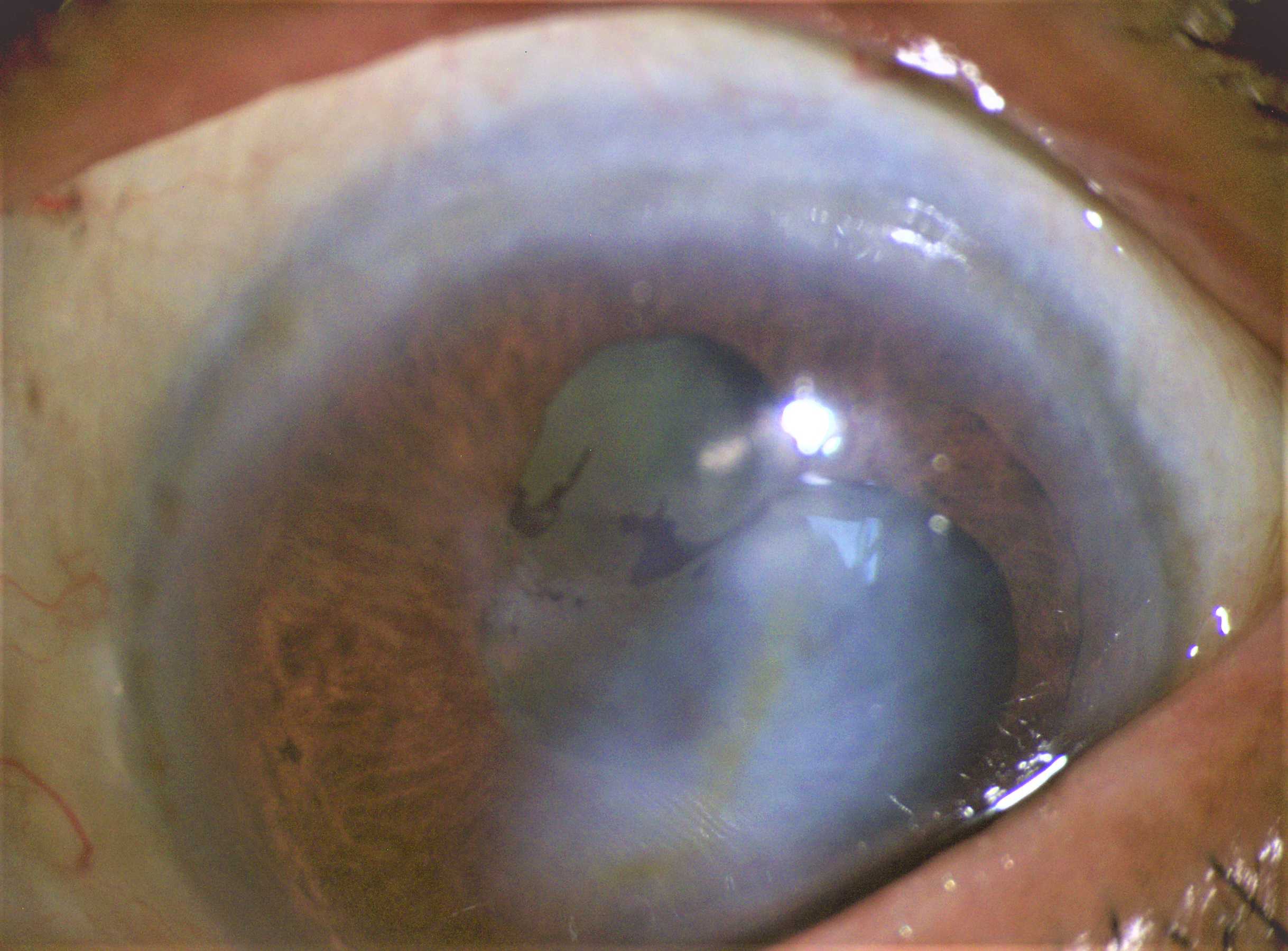 <p>Phacolytic Glaucoma</p>