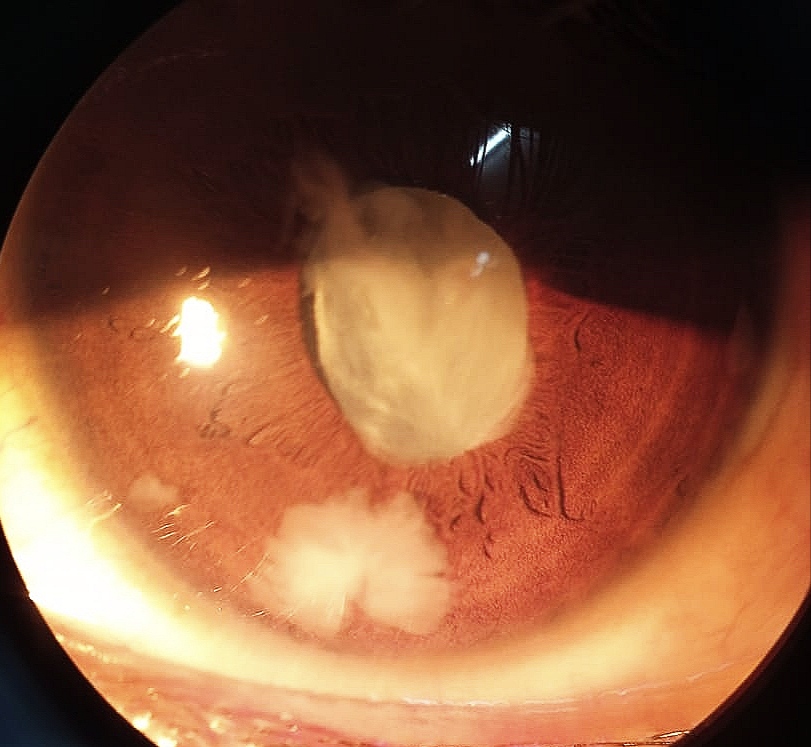 <p>Lens Particle Glaucoma</p>