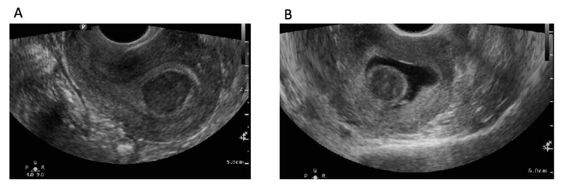 A: TVUS image of sagittal uterus with well circumscribed, suspected uterine fibroid within the endometrium