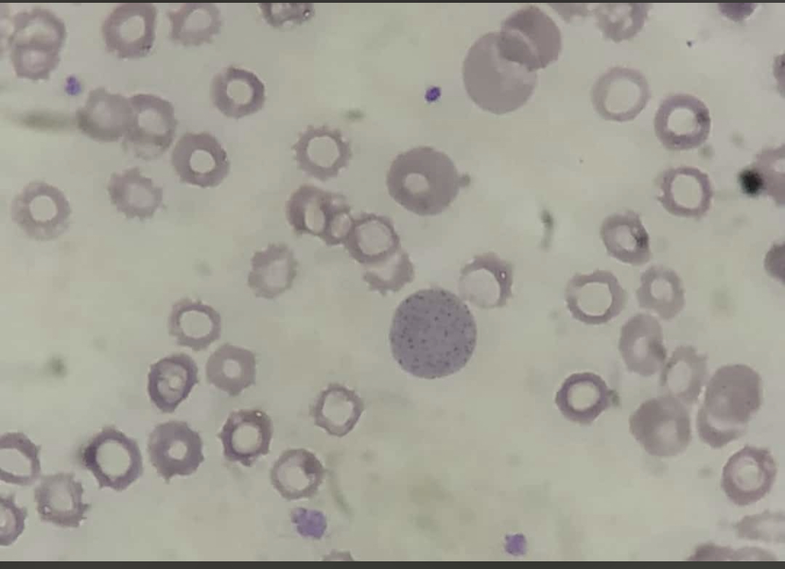 Basophilic stippling on peripheral blood smear