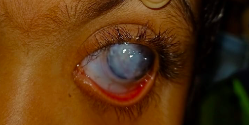 <p>Chronic Primary Congenital Glaucoma