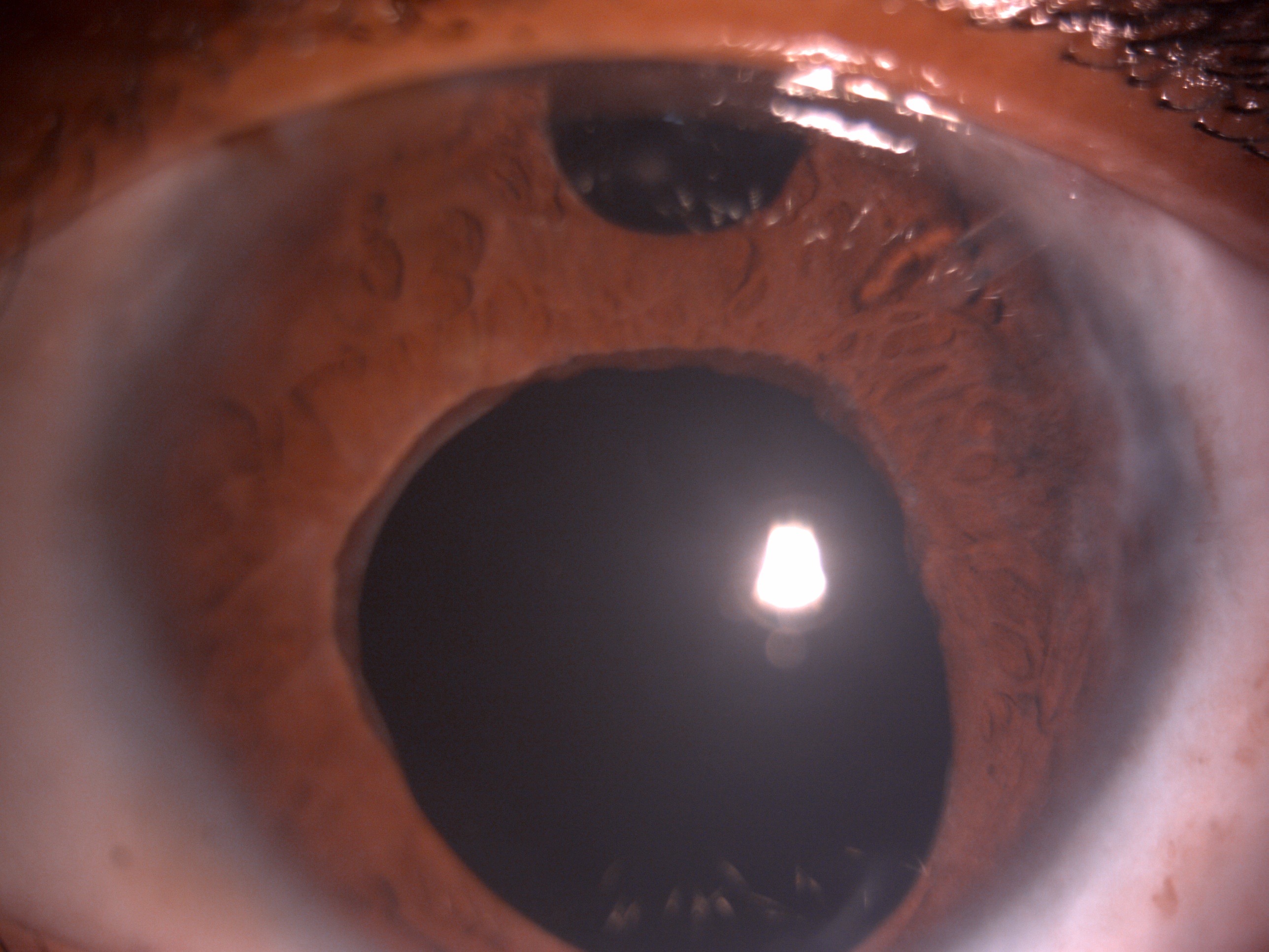 <p>Glaucoma Drainage Device