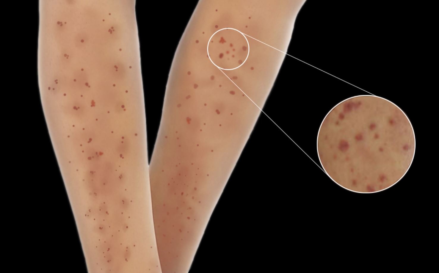 Typical skin changes seen in microscopic polyangiitis.