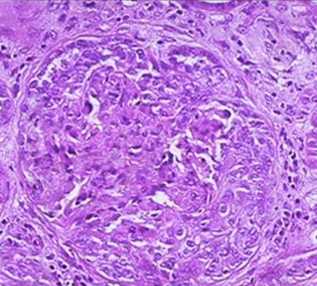 <p>Crescentic Glomerulonephritis. Renal biopsy showing crescentic glomerulonephritis seen in Goodpasture syndrome.</p>