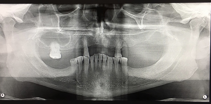 <p>Right and Left Maxillary Sinuses, Panoramic Radiograph.</p>