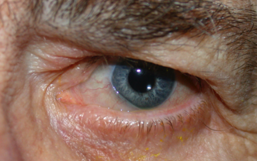 Photograph showing conjunctivochalasis in the left eye (male patient) 
