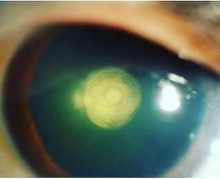 Classical slit lamp image of the patient depicting onion ring shaped discoid plaque like opacity densely adherent to the cent