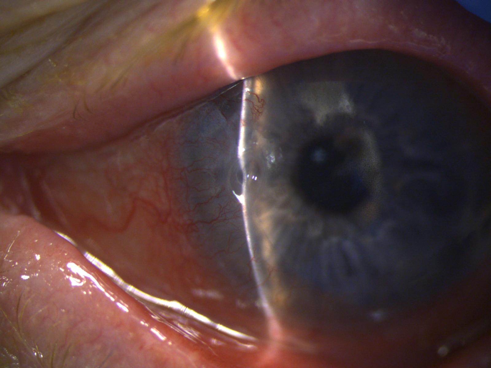 <p>Peripheral Ulcerative Keratitis in&nbsp;Rheumatoid Arthritis