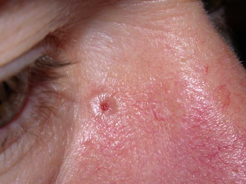 <p>Nodulocystic Basal Cell Carcinoma