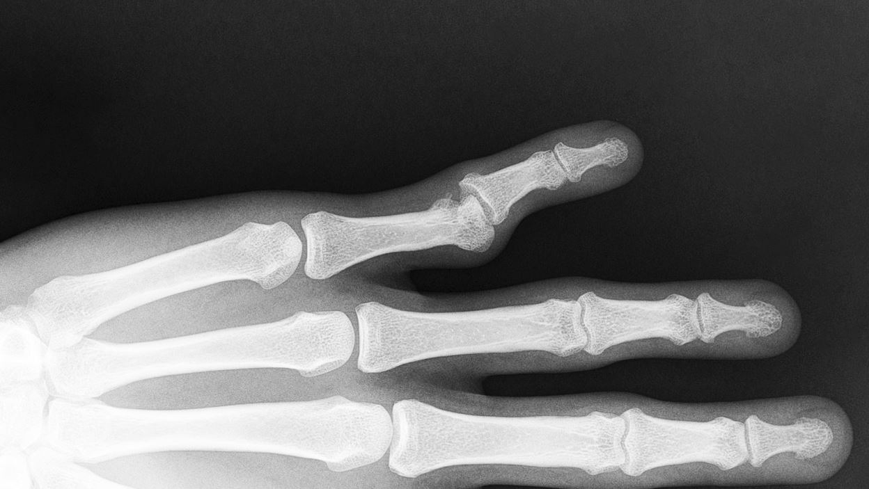 Radiograph of a left PIP dislocation.