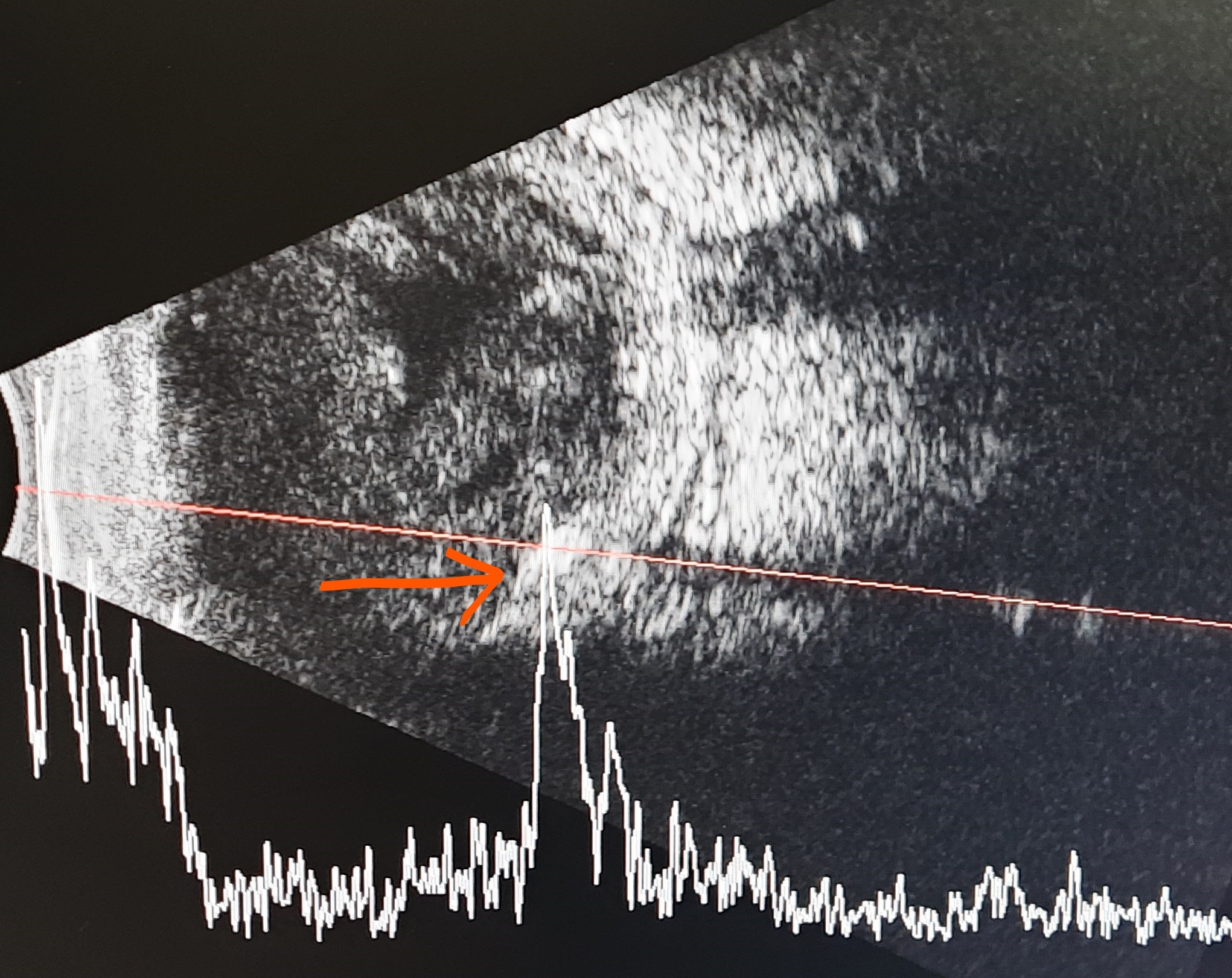 Ultrasound B scan of eye showing a metallic foreign body over the retina (orange arrow)