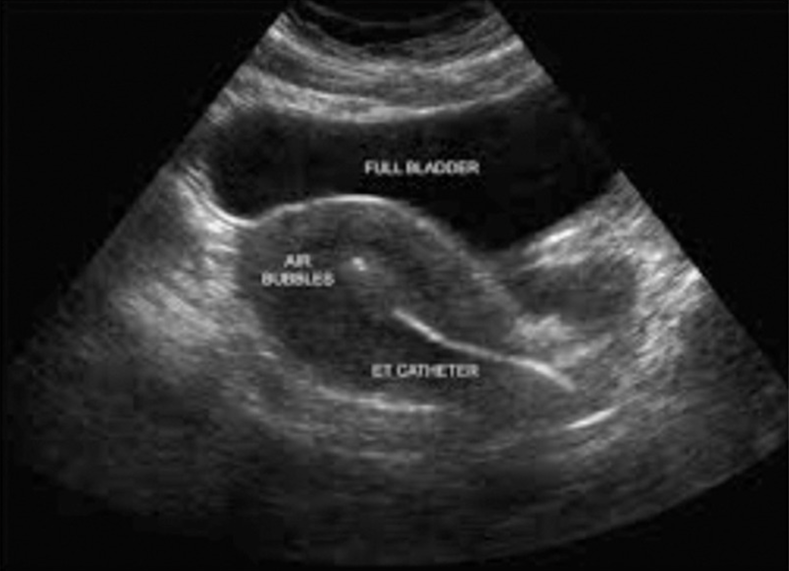 Trans-abdominal ultrasound-guided embryo transfer