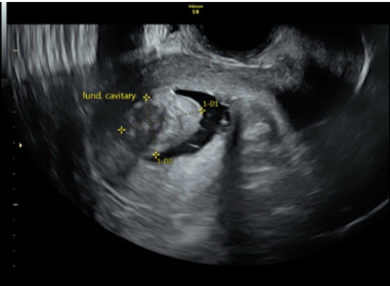 Saline infusion sonohysterogram of intracavitary fibroid