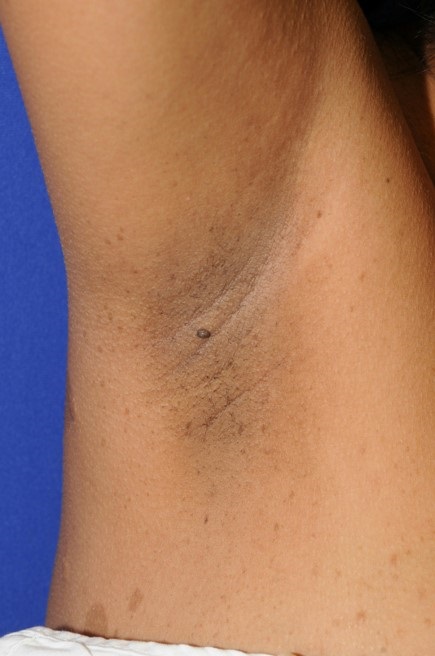 Axillary freckling in Neurofibromatosis type 1