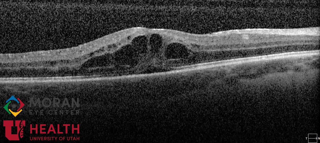 <p>Cystoid Macular Edema, Uveitis