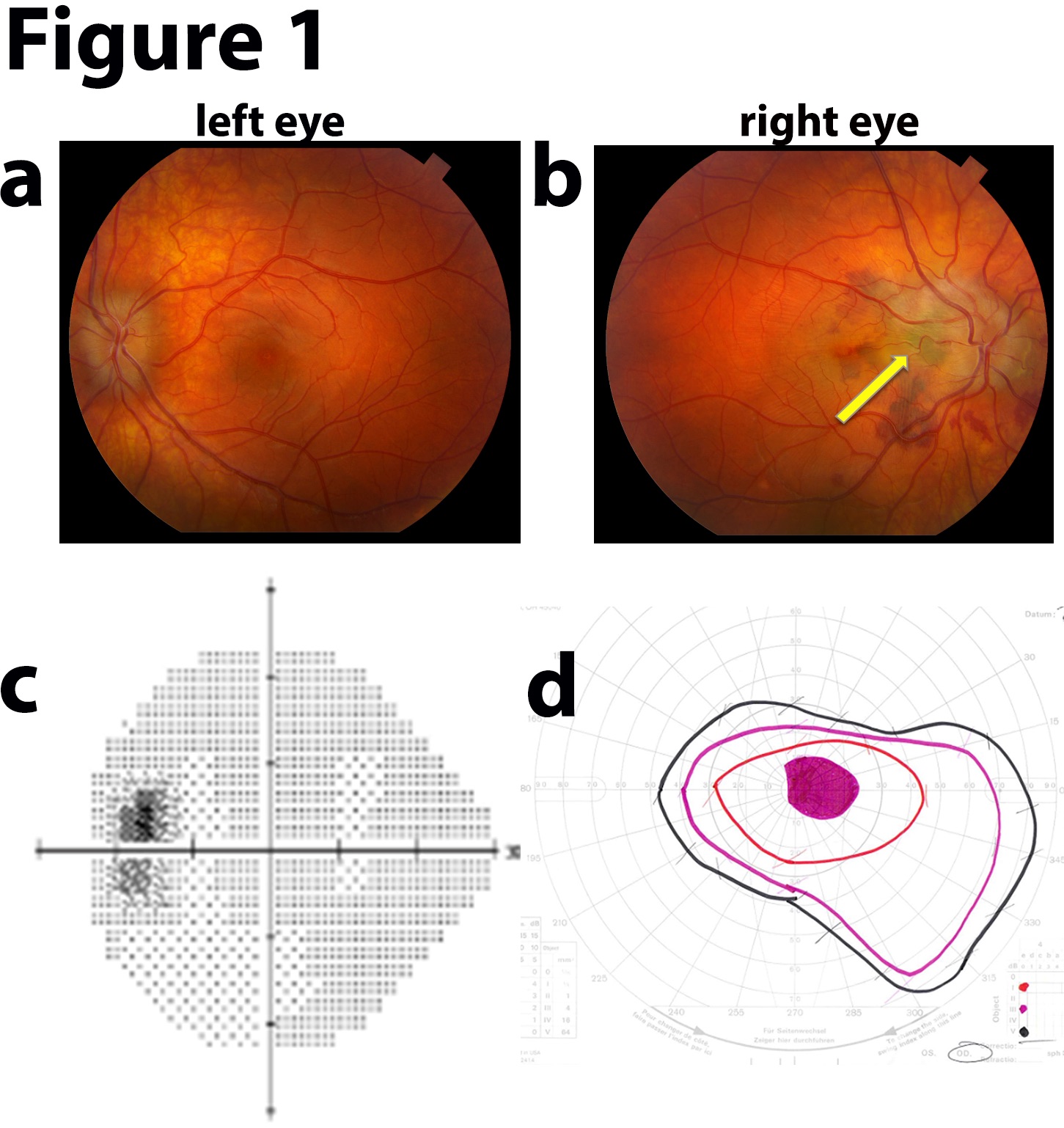 <p>Idiopathic Intracranial Hypertension Fundus Examination