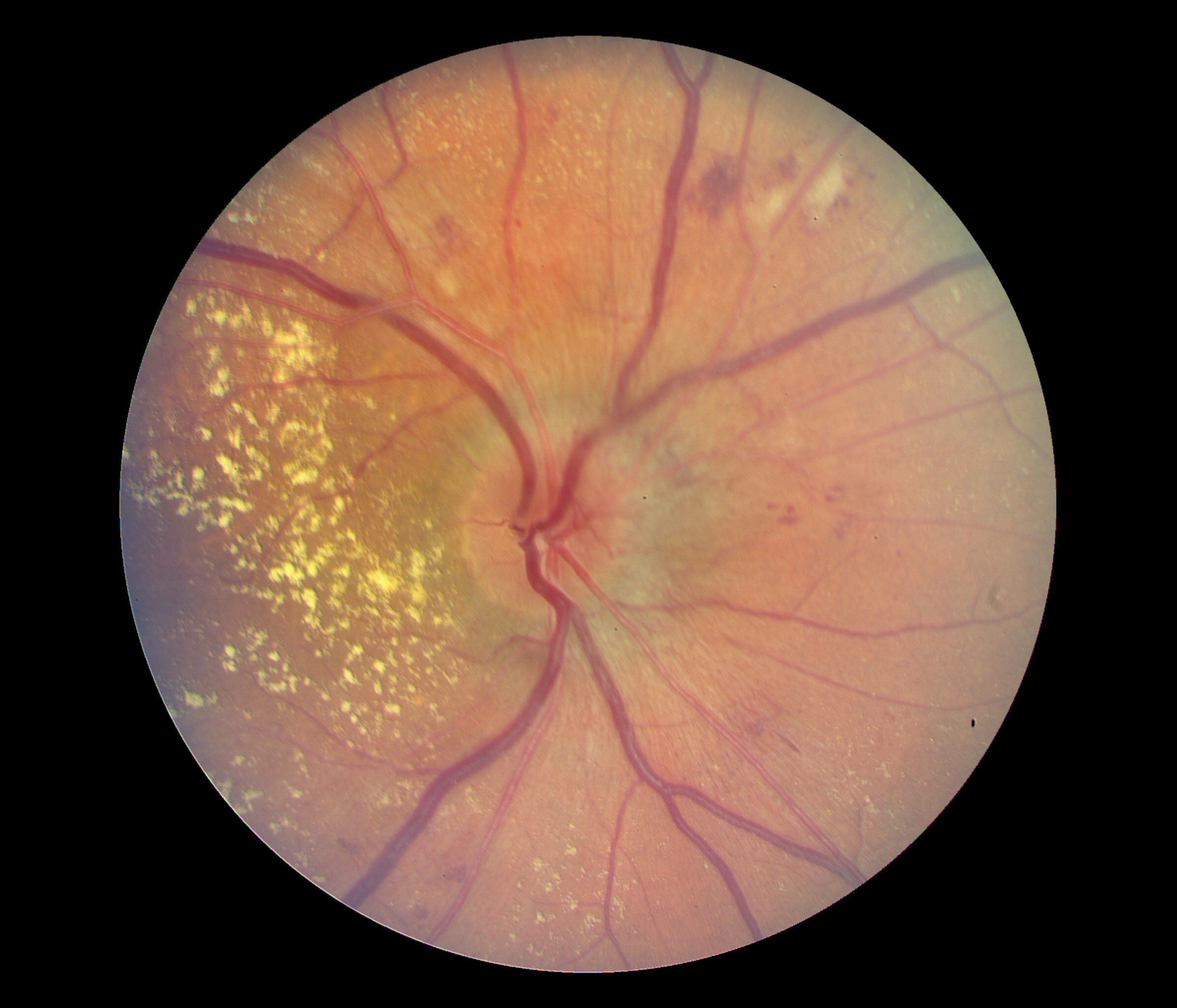 <p>Macular Edema Associated with Hypertensive Retinopathy