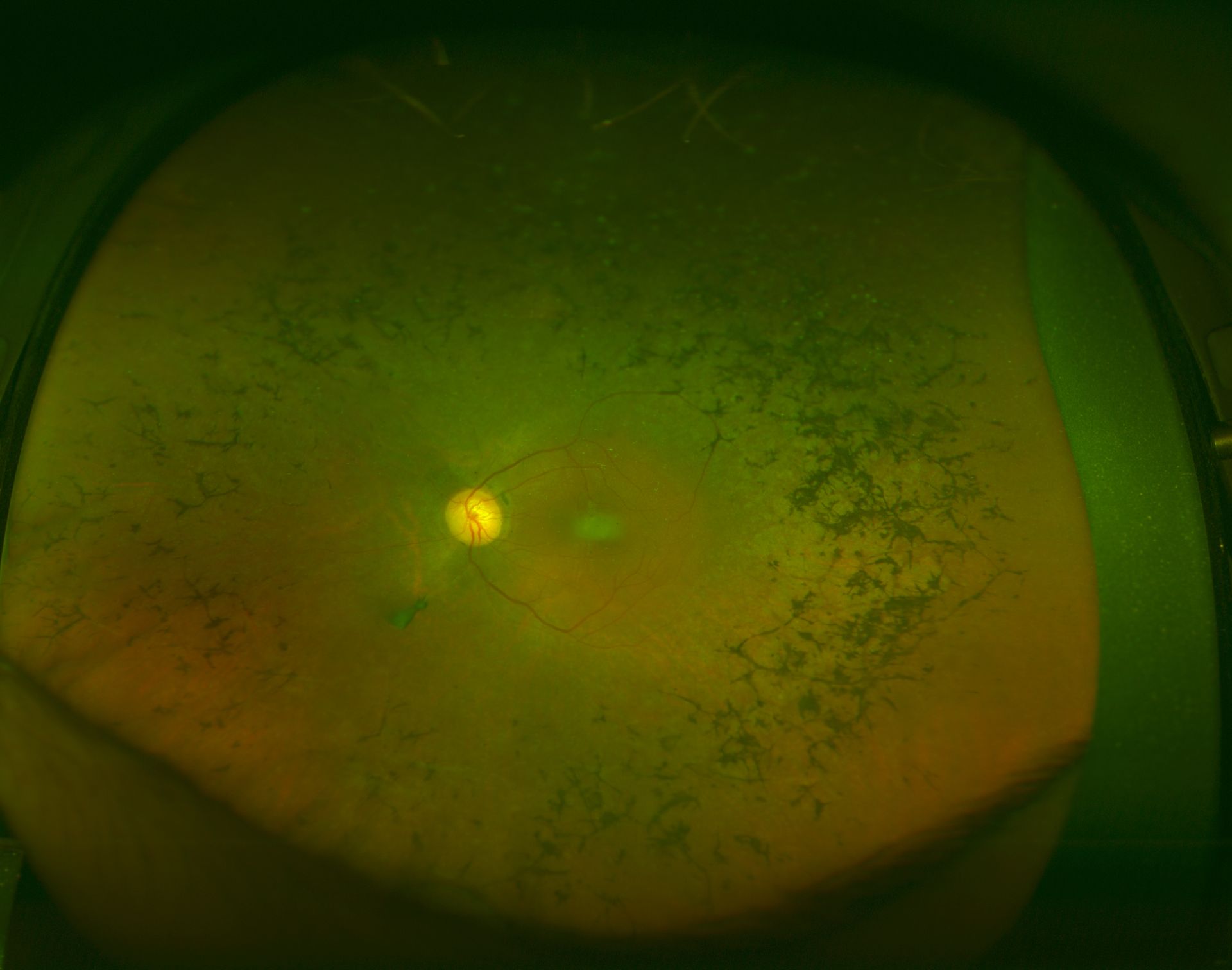 <p>Retinitis Pigmentosa</p>