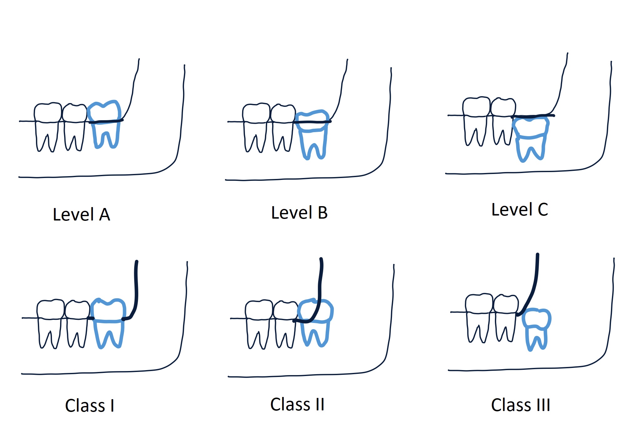 <p>Pell and Gregory Classification</p>