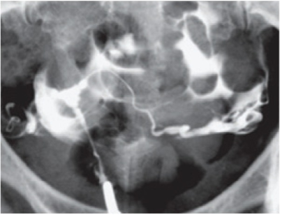 <p>Classic &ldquo;T-shaped&rdquo; Uterus on Hysterosalpingogram