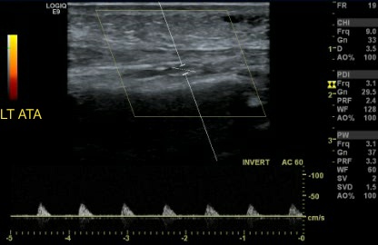 Monophasic Arterial Waveform