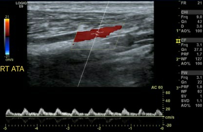 Monophasic Tardus parvus waveform