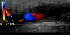 Pseudoaneurysm showing the classic 'yin-yang' color flow.