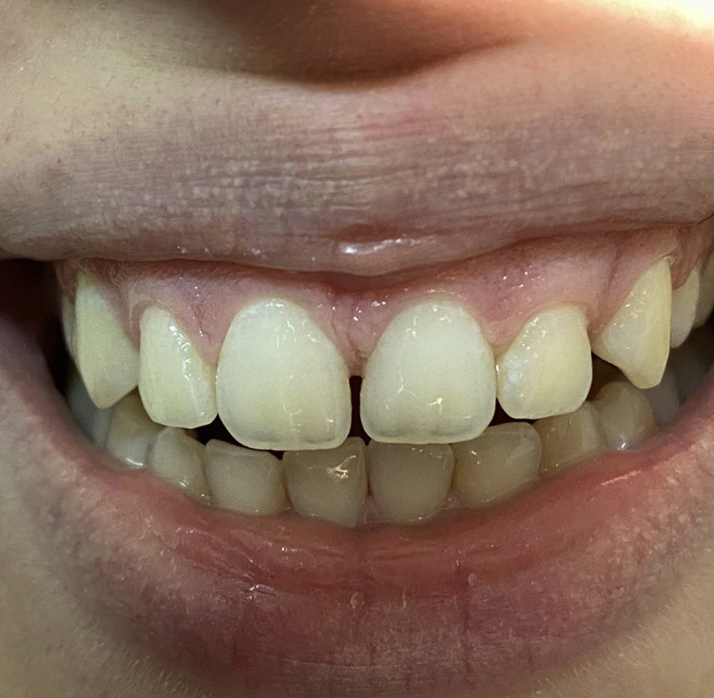 <p>Excessive Gingival Display, Multifactorial in Etiology.</p>