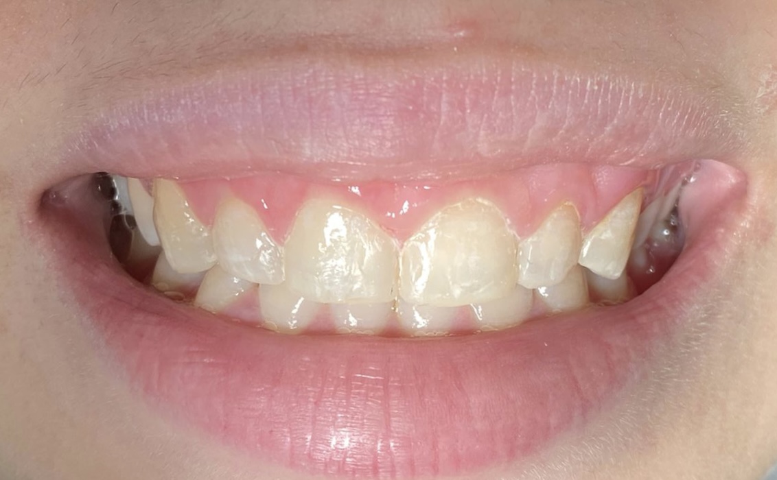 <p>Excessive Gingival Display,&nbsp;Overexposure of&nbsp;the Maxillary Gingiva.</p>