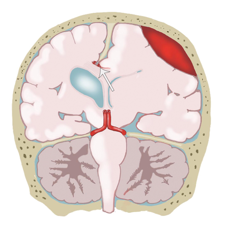 <p>Compression of the Pericallosal Artery