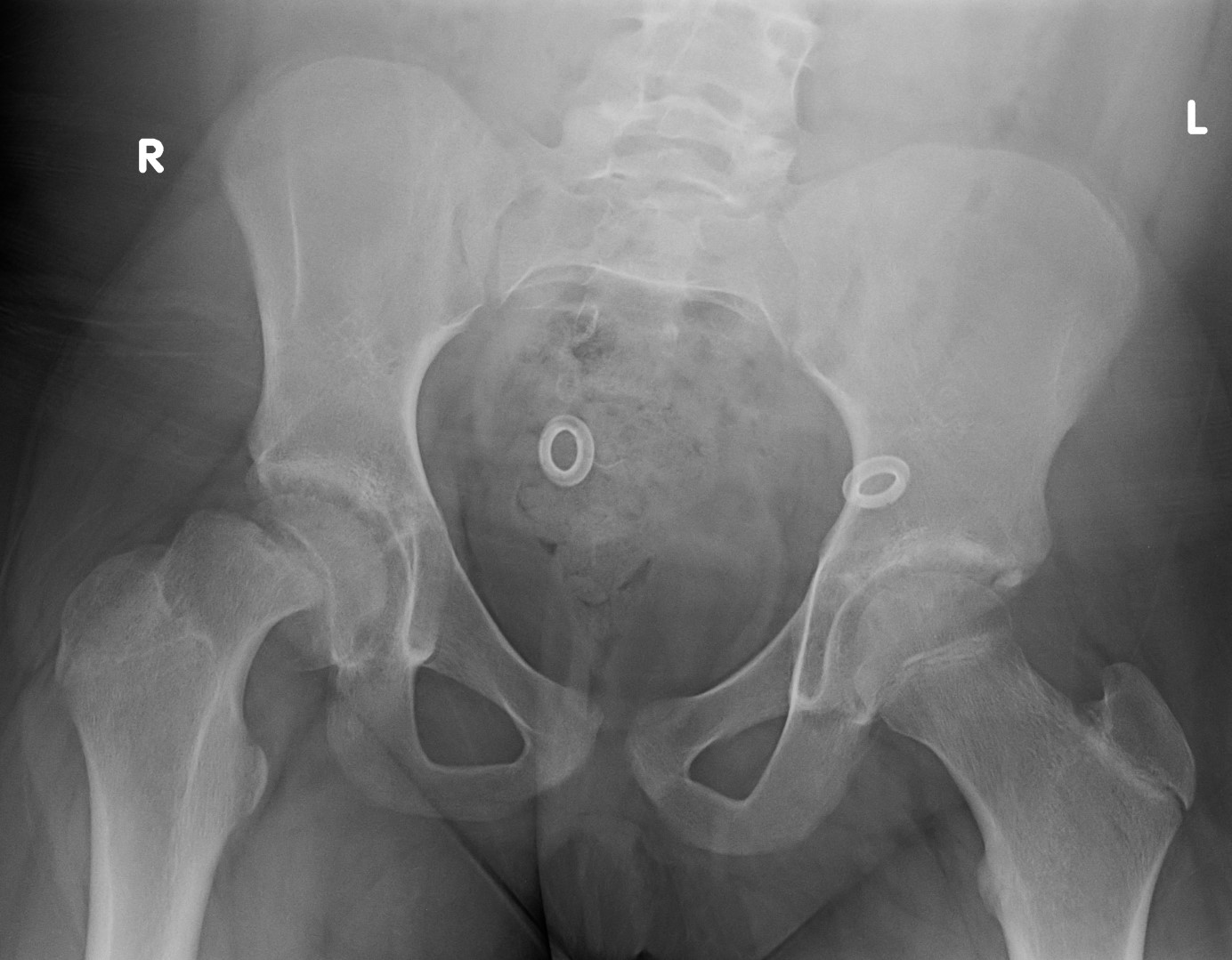 Slipped capital femoral epiphysis