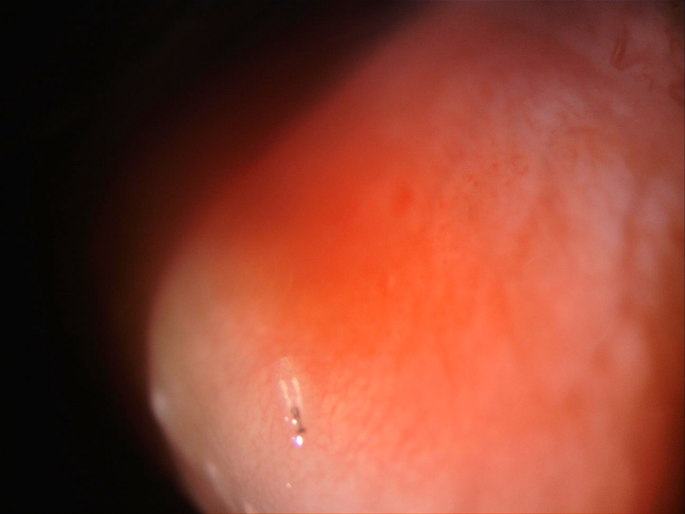 Botfly larva over the hyperemic palpebral conjunctiva.