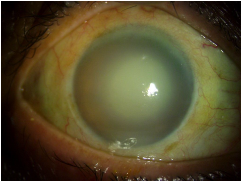 After treatment with  topical and systemic steoids and antiglaucoma medications, corneal edema decreased and a mature cataract was seen which was the reason for the lens induced inflammation