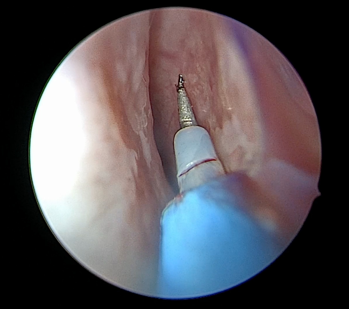 Needle point Bovie used to make mucosal incisions along nasal septum during nasoseptal flap elevation.