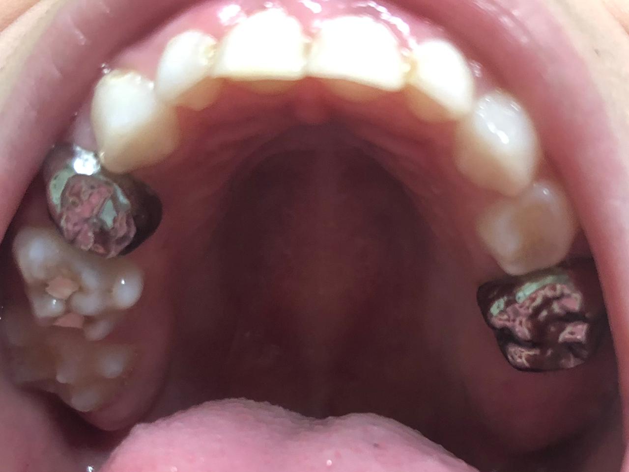 <p>Primary Dentition. This image shows stainless steel crowns in primary dentition.</p>