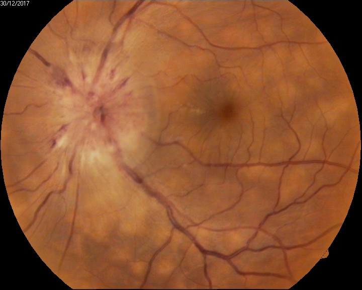 <p>Vogt-Koyanagi-Harada Syndrome. A fundus photograph of patient with Vogt-Koyanagi-Harada syndrome.</p>