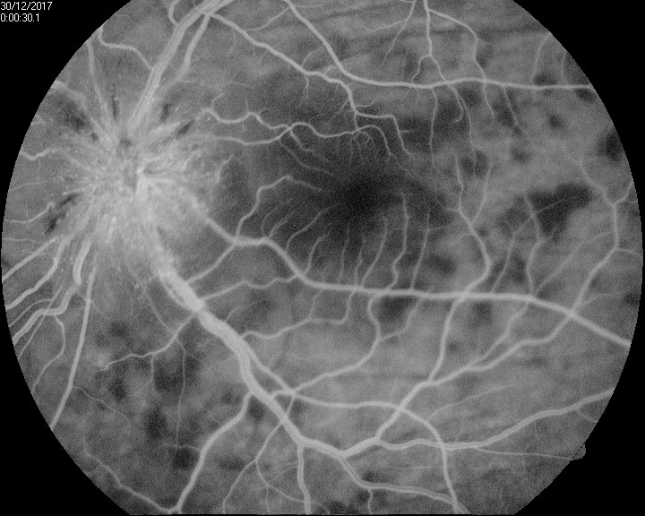 <p>Early Phase Vogt-Koyanagi-Harada Syndrome