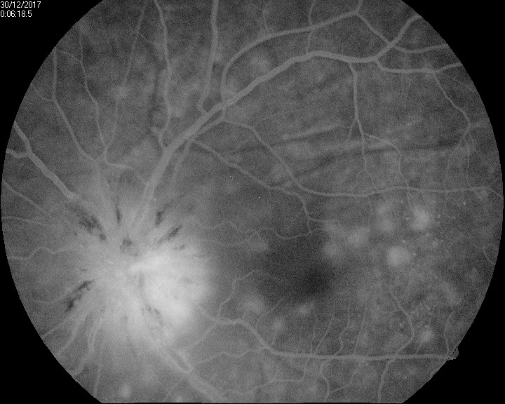 <p>Late Phase Vogt-Koyanagi-Harada Syndrome