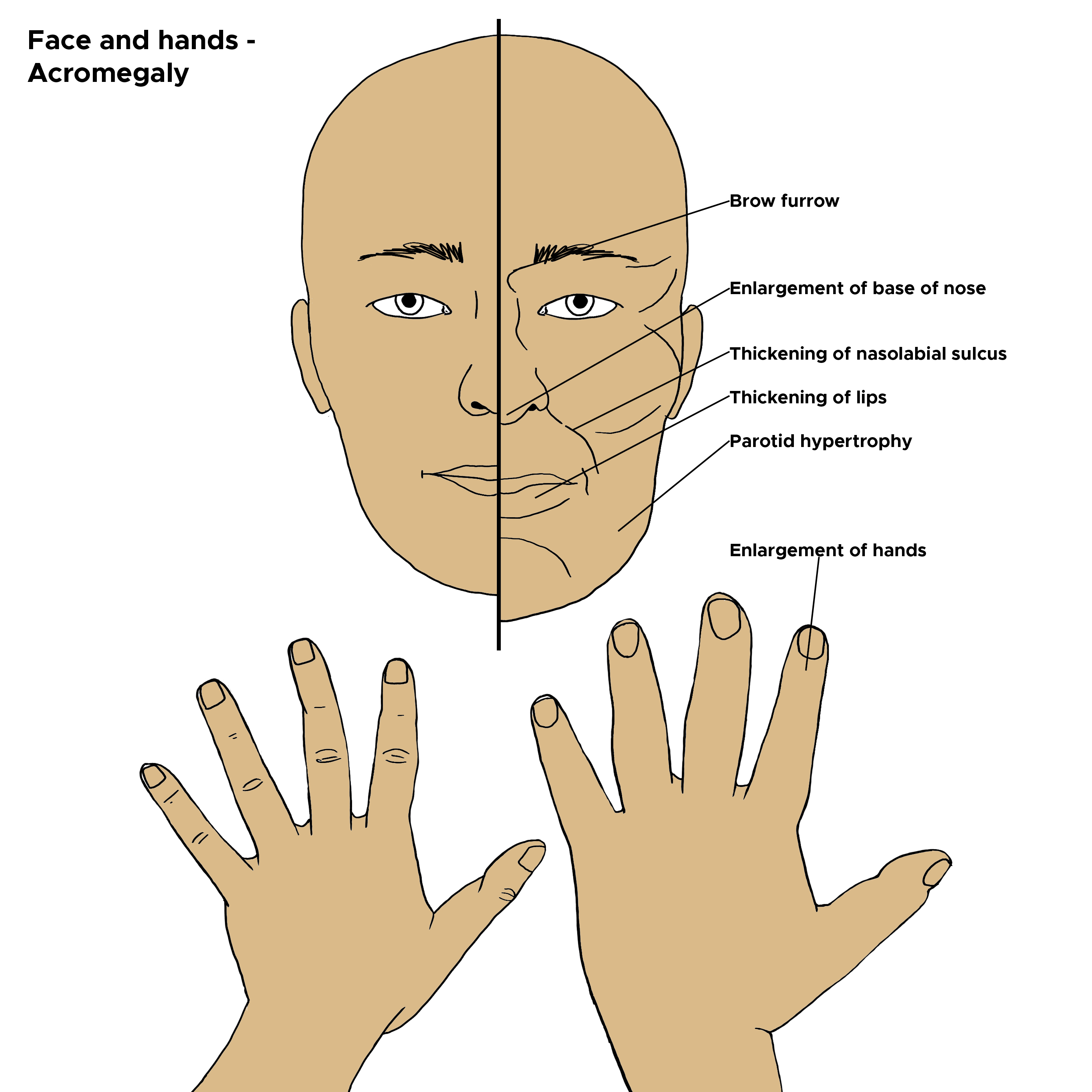 Illustration of physical attributes of face and hands. Acromegaly, gigantism.