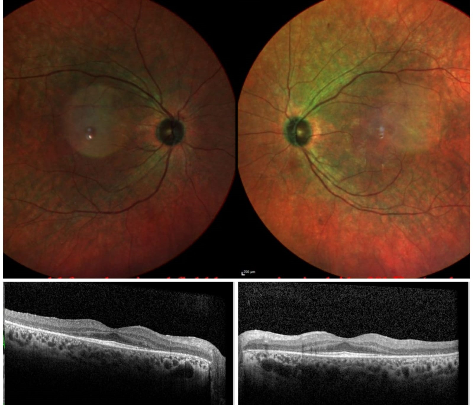 <p>Cancer-Associated Retinopathy